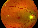 retinopatia_diabetica.jpg